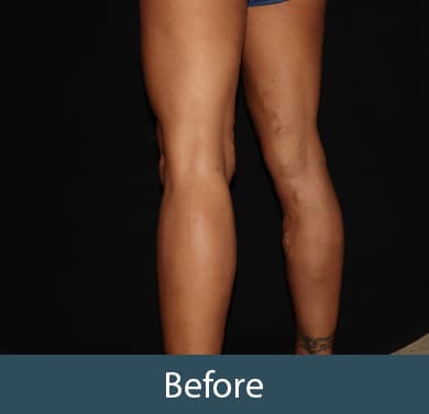 Vein Treatment Before & After Image