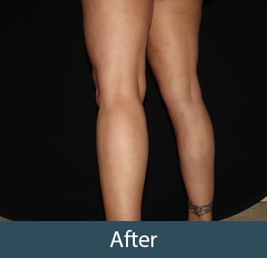 Vein Treatment Before & After Image