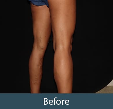 Vein Treatment Before & After Image