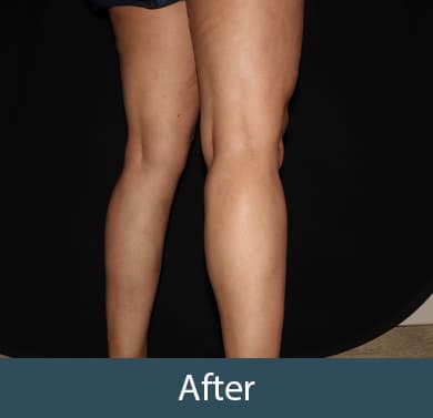 Vein Treatment Before & After Image