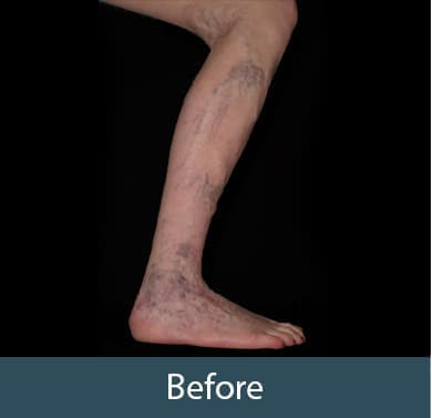 Vein Treatment Before & After Image