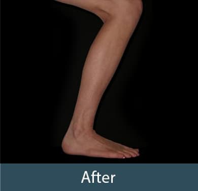 Vein Treatment Before & After Image