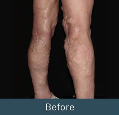 Vein Treatment Before & After Image