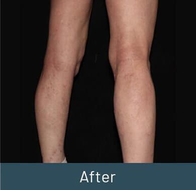 Vein Treatment Before & After Image