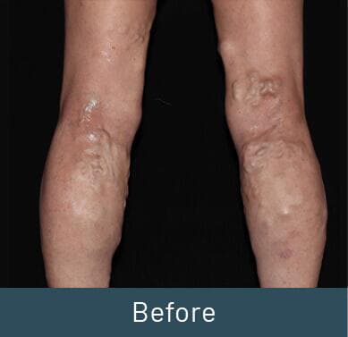 Vein Treatment Before & After Image