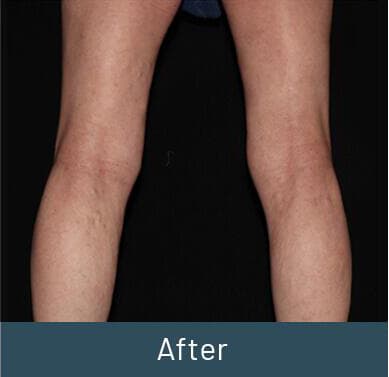 Vein Treatment Before & After Image