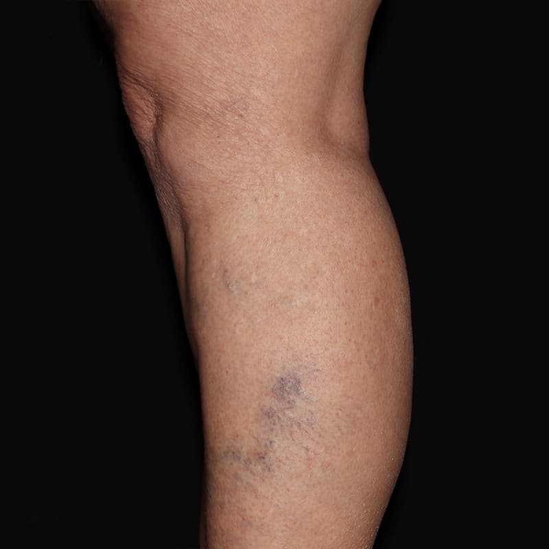 Vein Treatment Before & After Image
