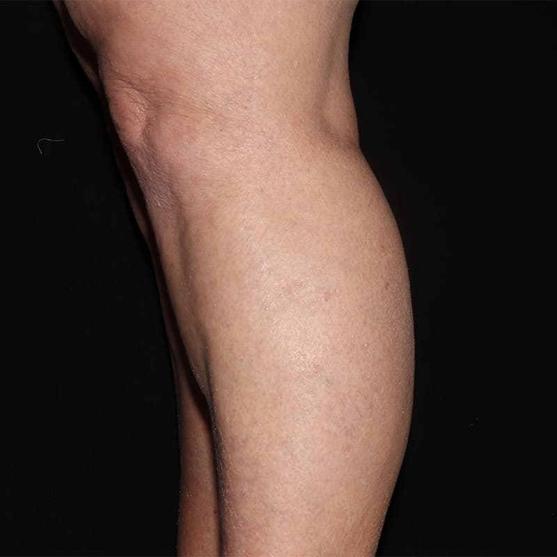 Vein Treatment Before & After Image