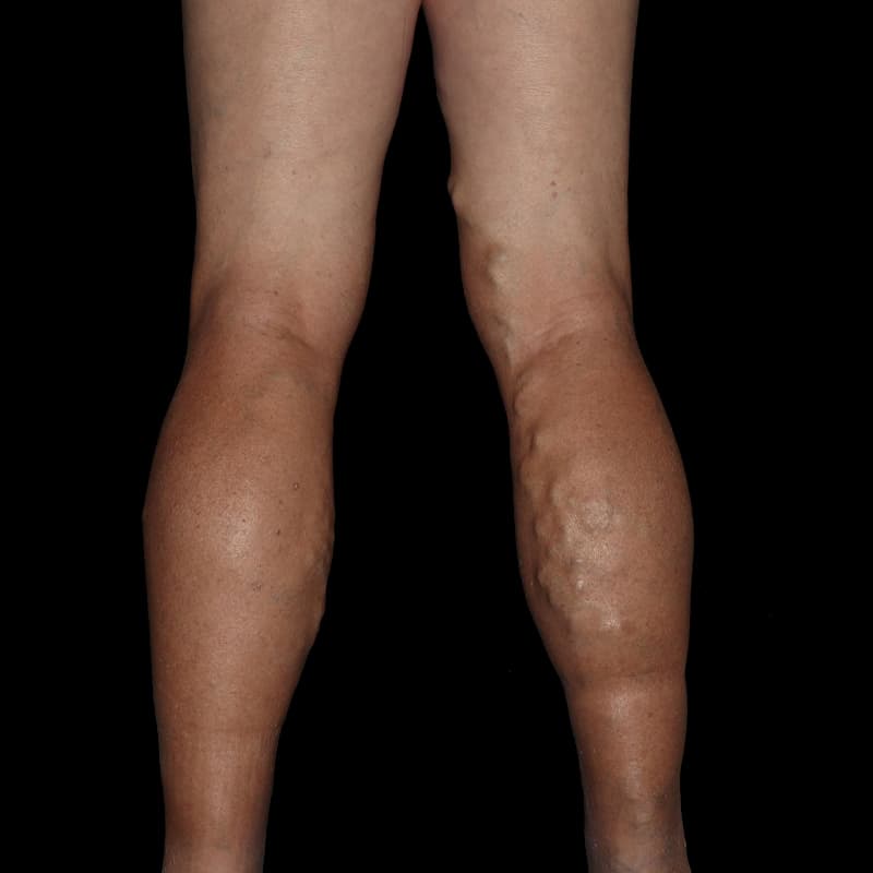Vein Treatment Before & After Image