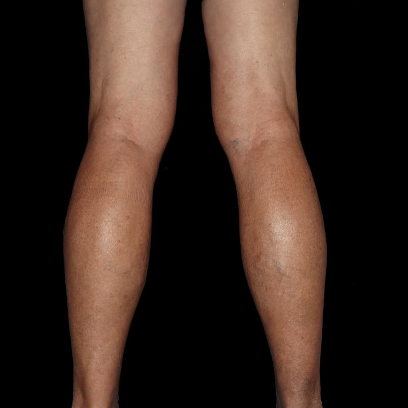 Vein Treatment Before & After Image