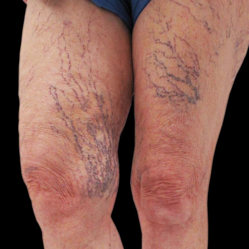 Vein Treatment Before & After Image