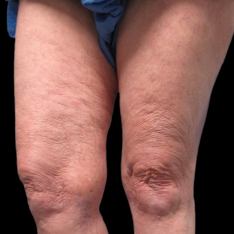 Vein Treatment Before & After Image
