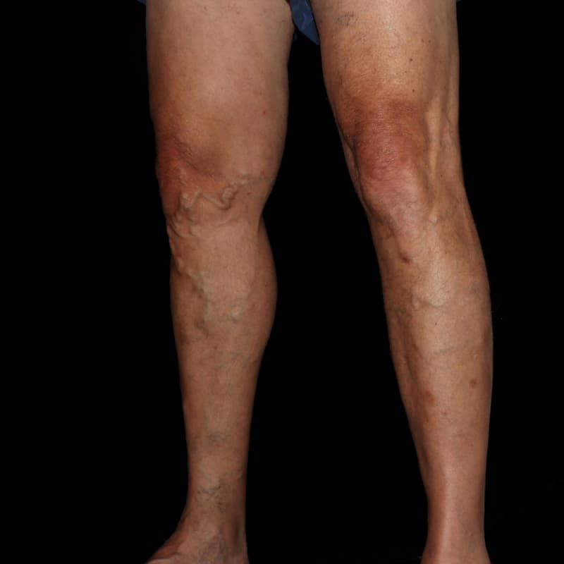 Vein Treatment Before & After Image