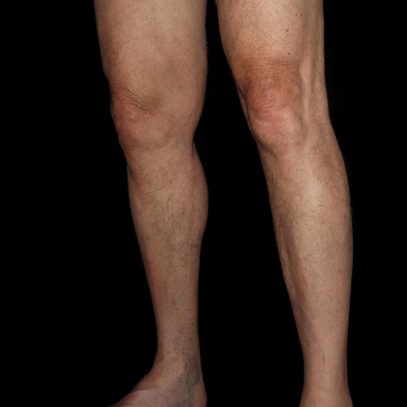 Vein Treatment Before & After Image