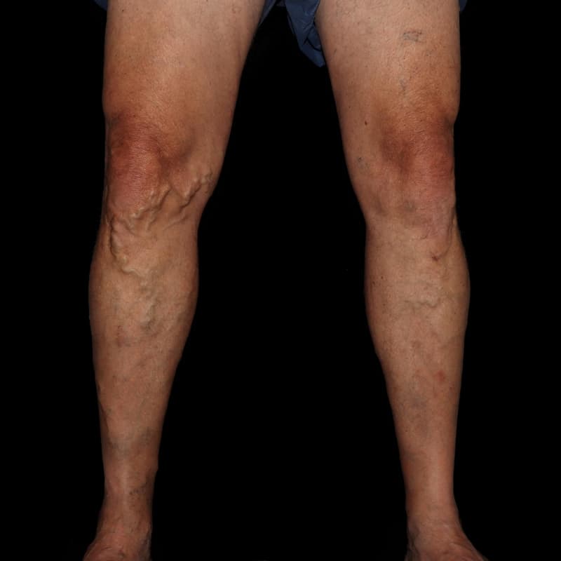 Vein Treatment Before & After Image