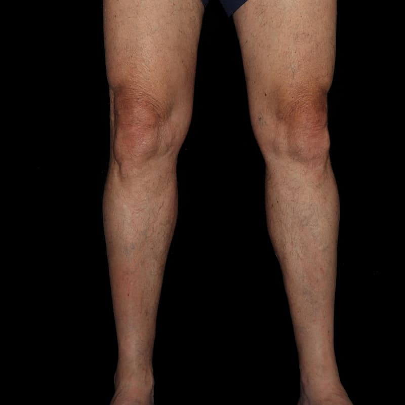 Vein Treatment Before & After Image